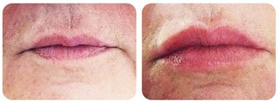 Lip Enhancement 